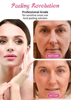 Эксфолирующая сыворотка для кожи 15% Peeling Solution Профессиональная сыворотка для эпиляции кожи