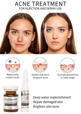 Сыворотка Mesotherapy впрыски обработки угорь Stalidearm не кормя никакие побочные эффекты